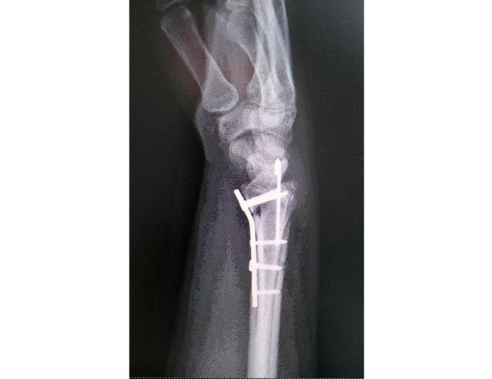 В Дубне врачи прооперировали пациентку со сложным переломом кисти